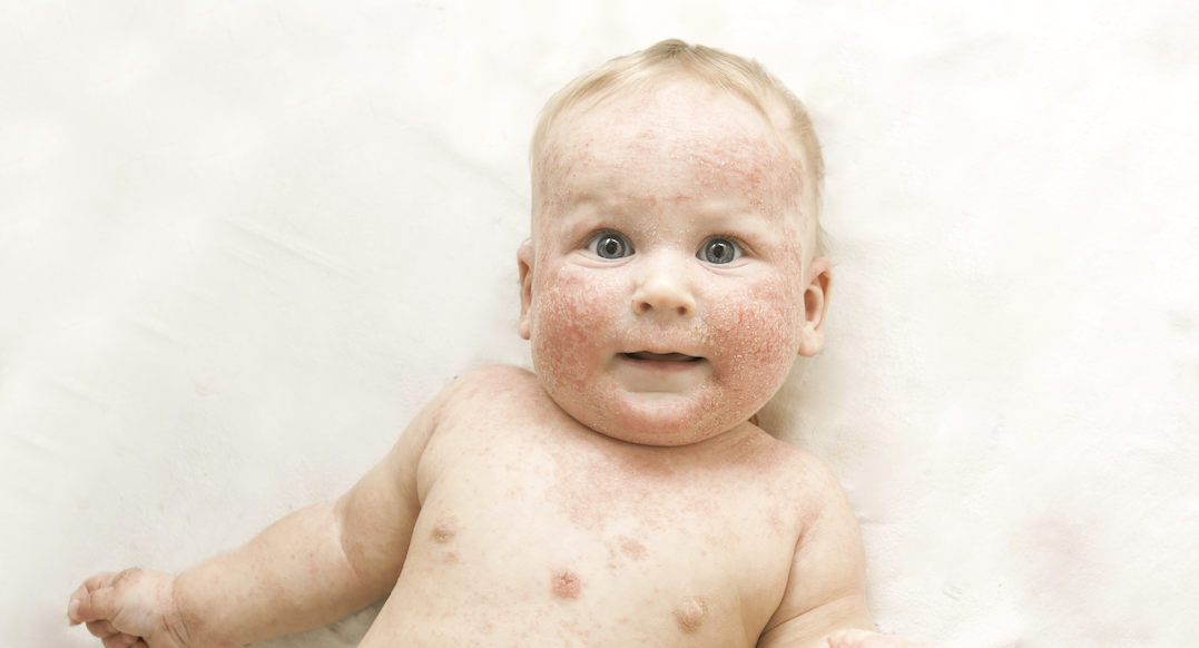 Eczema in Children