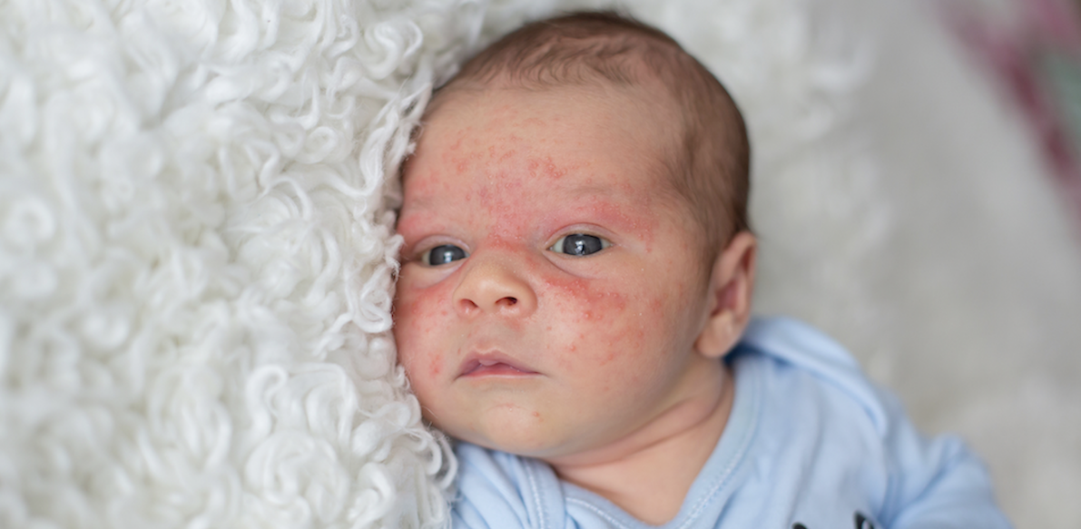 Caring for a Baby’s Sensitive or Eczema Skin