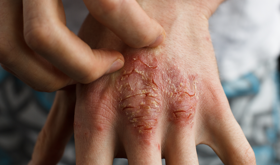 Eczema in the Workplace