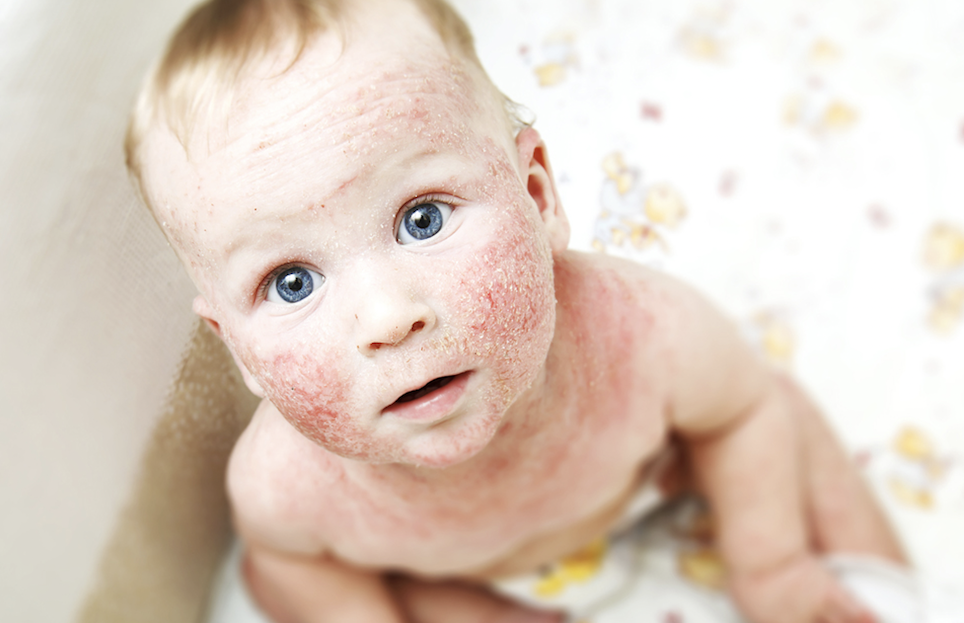 Eczema in Children 