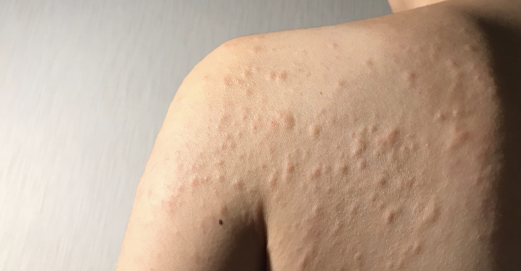 Hives Symptoms: What They Look Like