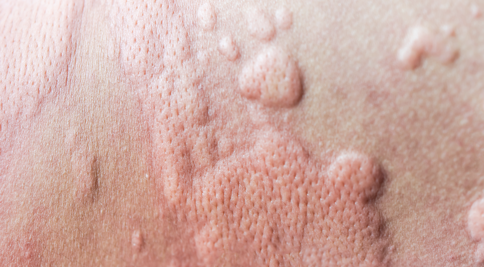 Urticaria (Hives) and Other Skin Allergy