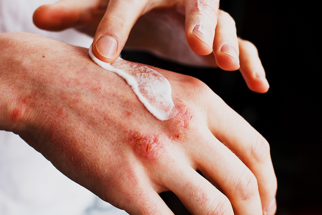 Atopic Dermatitis (Eczema): Triggers, Allergens and Irritants