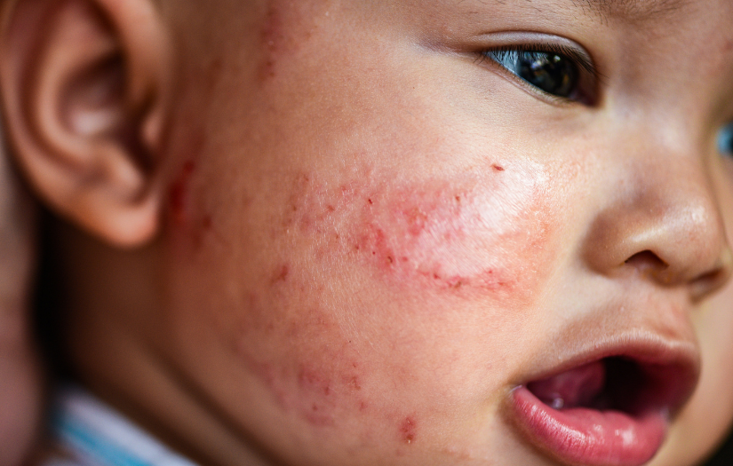 Caring for a Baby's Sensitive or Eczema Skin