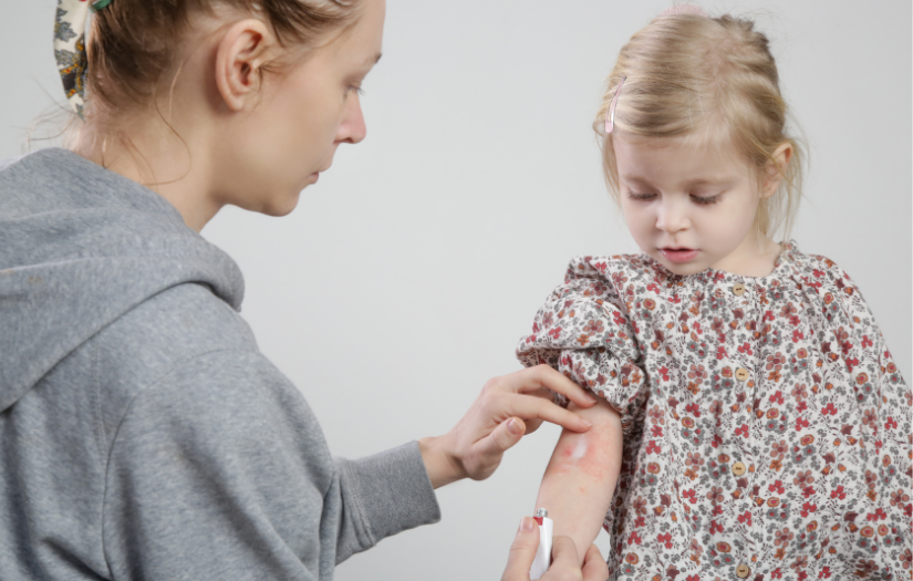 Emollients and Steroid Treatments for Children