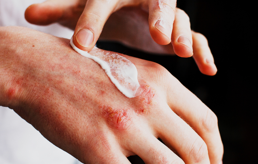 Emollients for Adults with Eczema