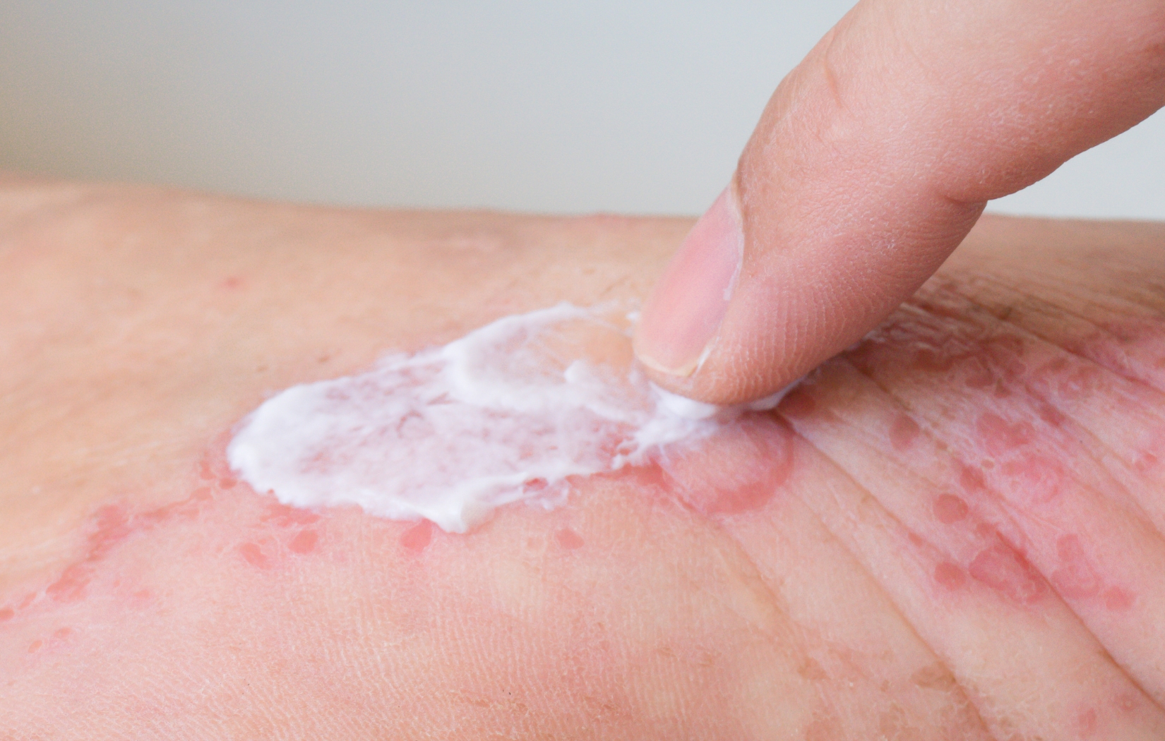 Applying Topical Treatments for Eczema