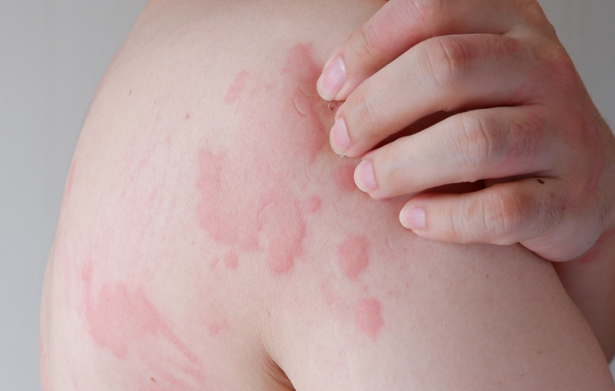 Urticaria and Other Skin Allergy, Allergy UK