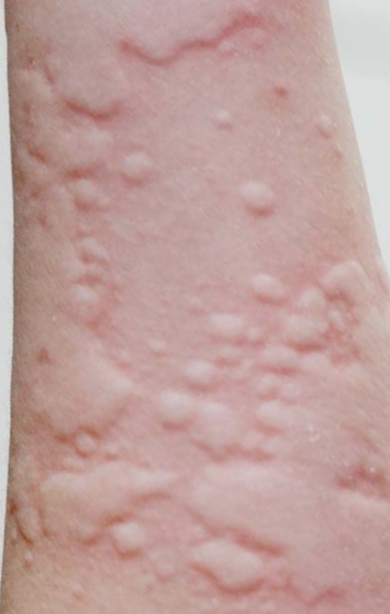 Chronic Spontaneous Urticaria Leaflet Allergy UK National Charity