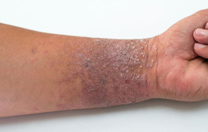 Coping with Eczema as an Adult