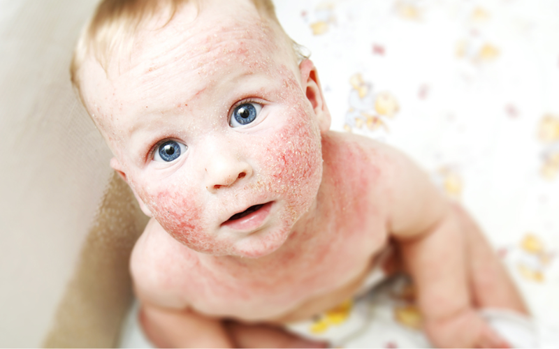 Eczema in children