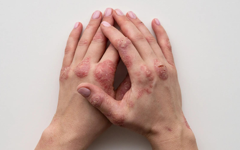 Eczema triggers, allergens and irritants