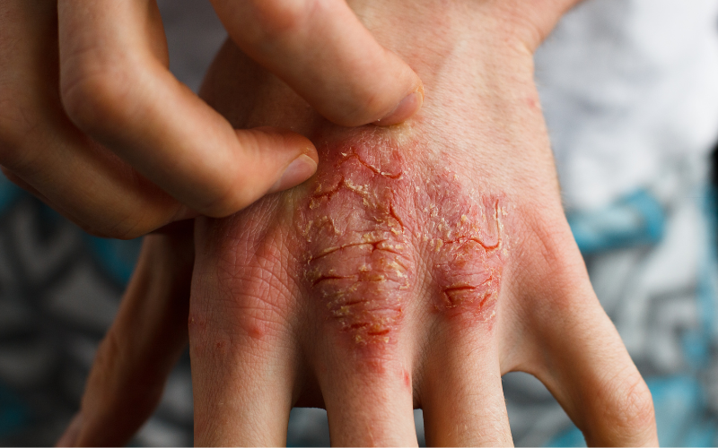 Eczema in adults