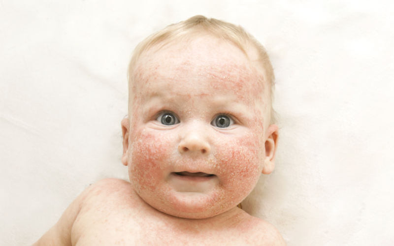 Caring for a baby's sensitive or eczema skin: Video resource