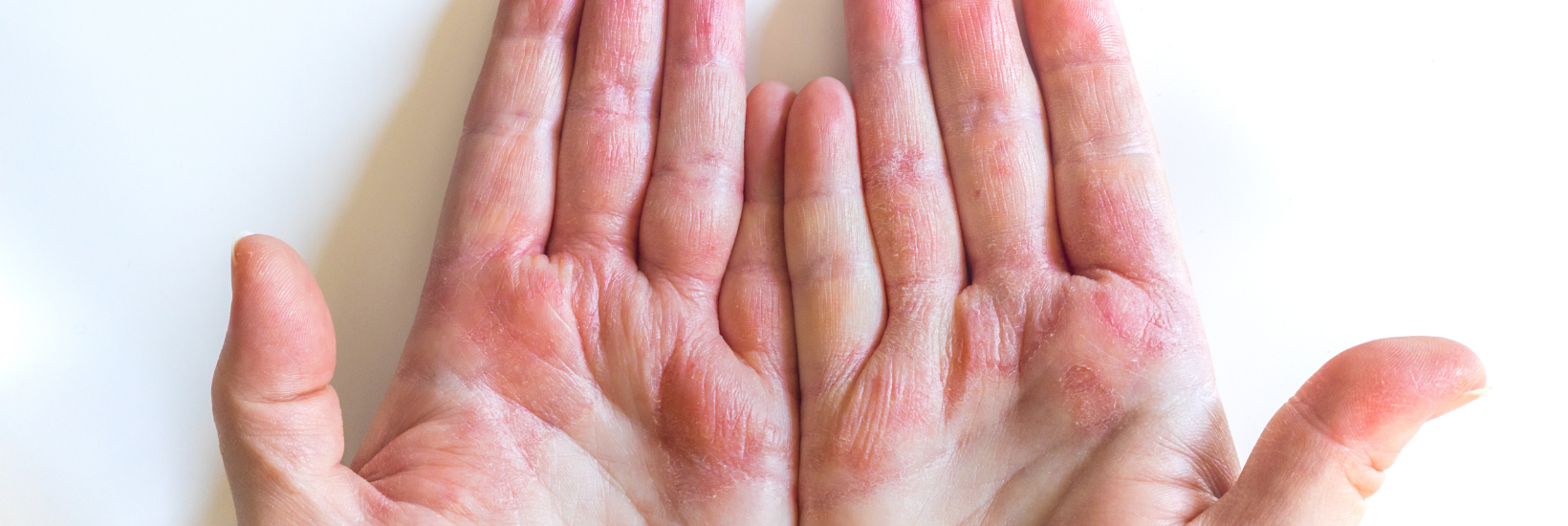 Research to understand the impact of hand eczema in the UK